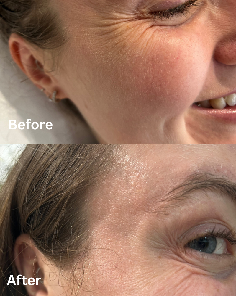 Anti Wrinkle Injections Nottingham