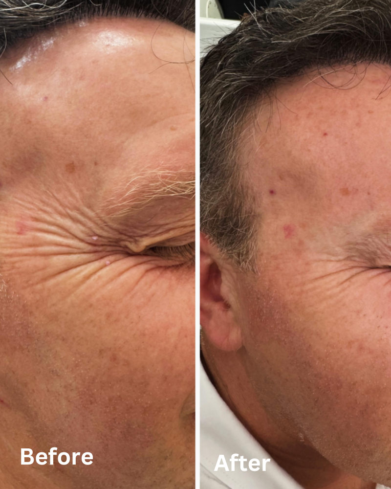 Anti Wrinkle Injections Nottingham